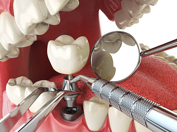 Best Emergency Broken Tooth Repair in Willimantic, CT